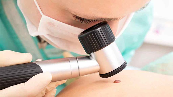 doctor checks mole for skin cancer